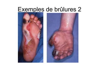 Exemples de brûlures 2
 