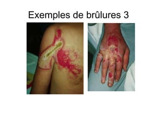 Exemples de brûlures 3
 