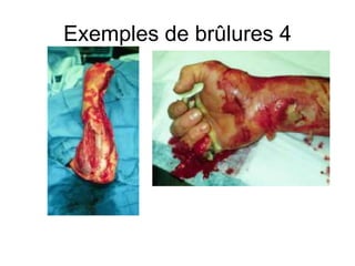 Exemples de brûlures 4
 