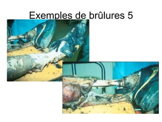 Exemples de brûlures 5
 