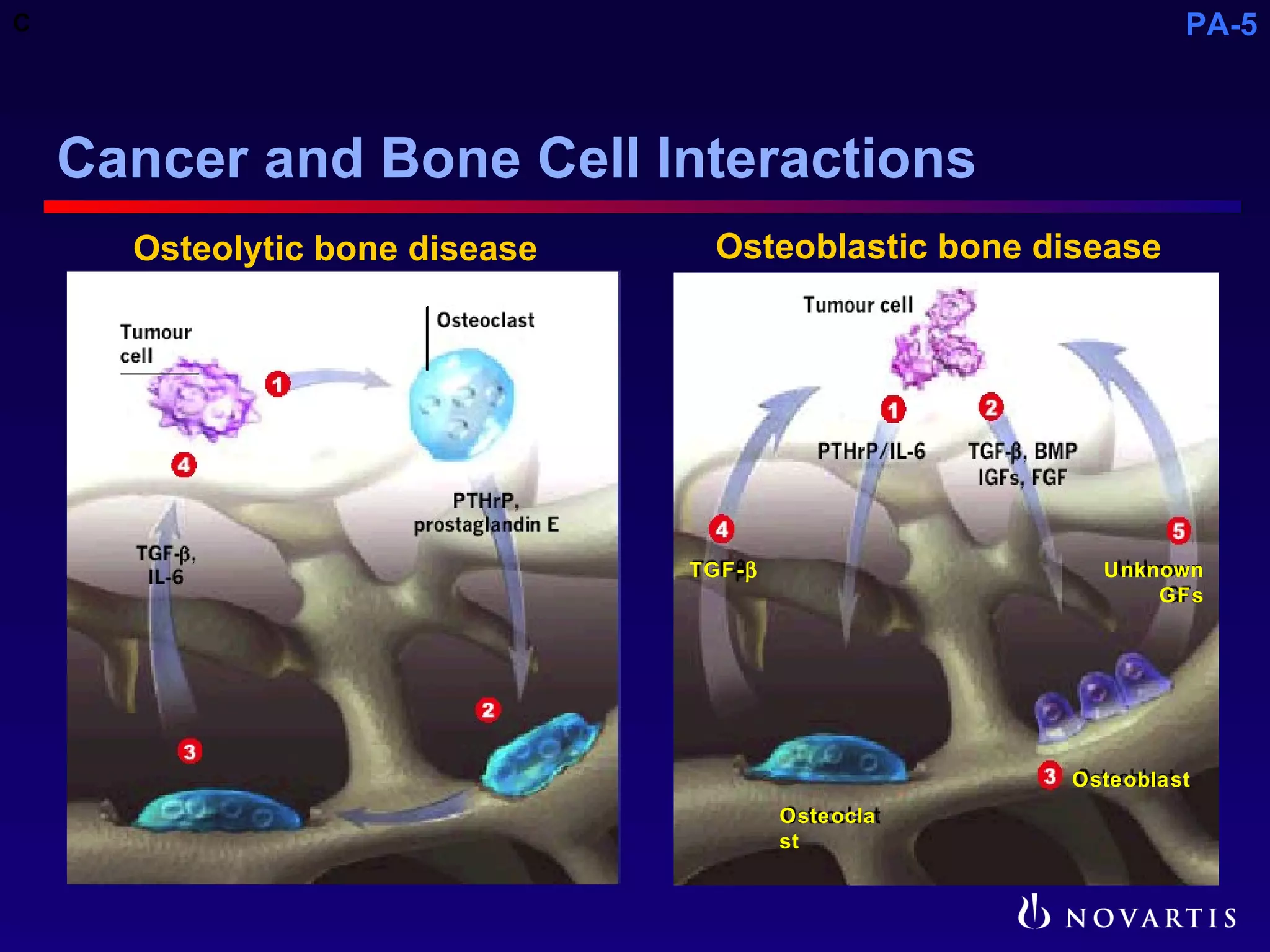 Pathophysiology of Metastatic Bone Disease and the Role of ...