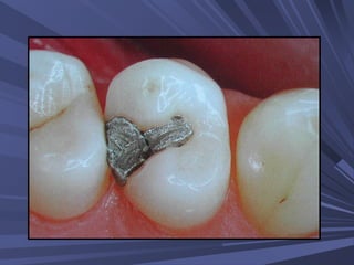 (38)(39)''32 amalgam restorations | PPT
