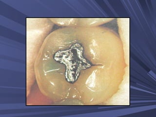 (38)(39)''32 amalgam restorations | PPT