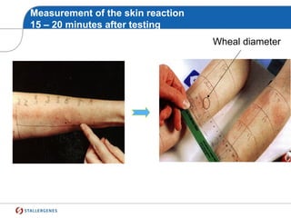 Measurement of the skin reaction
15 – 20 minutes after testing
Wheal diameter
 