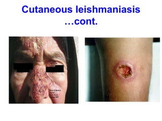 Cutaneous leishmaniasis
…cont.
 
