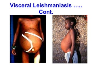 Visceral Leishmaniasis …..
Cont.
 