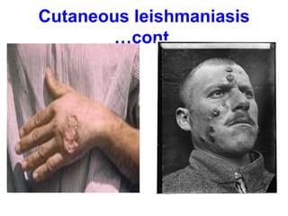 Cutaneous leishmaniasis
…cont.
 