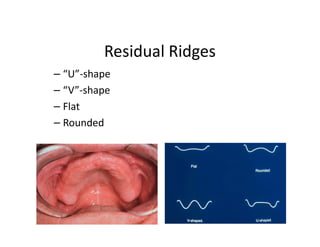 Residual Ridges
– “U”-shape
– “V”-shape
– Flat
– Rounded
 