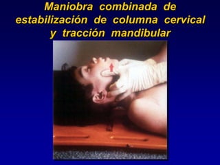 Maniobra combinada de
estabilización de columna cervical
y tracción mandibular
 