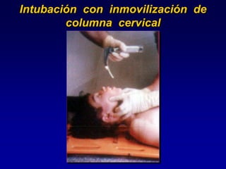 Intubación con inmovilización de
columna cervical
 