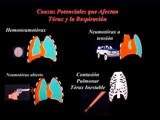Causas Potenciales que Afectan
Tórax y la Respiración
Hemoneumotórax Neumotórax a
tensión
Contusión
Pulmonar
Tórax Inestable
Neumotórax abierto
 
