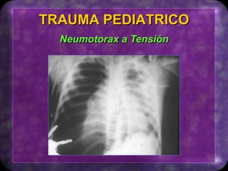 TRAUMA PEDIATRICO
Neumotorax a Tensión
 