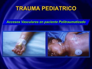TRAUMA PEDIATRICO
Accesos Vasculares en paciente Politraumatizado
 