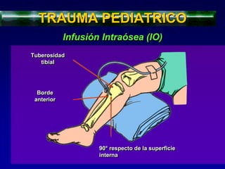 Tuberosidad
tibial
TRAUMA PEDIATRICO
Infusión Intraósea (IO)
Borde
anterior
90° respecto de la superficie
interna
 