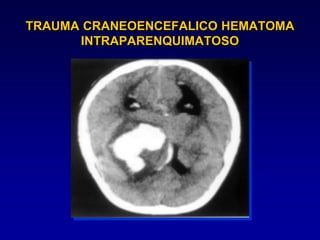 TRAUMA CRANEOENCEFALICO HEMATOMA
INTRAPARENQUIMATOSO
 
