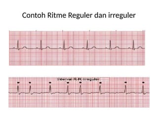 Vorm Ritme Panduan Lengkap Interpretasi EKG: Frekuensi, Ritme, dan Morfologi ...