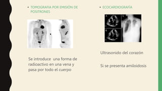 • TOMOGRAFIA POR EMISIÓN DE
POSITRONES
Se introduce una forma de
radioactivo en una vena y
pasa por todo el cuerpo
• ECOCARDIOGRAFÍA
Ultrasonido del corazón
Si se presenta amiloidosis
 