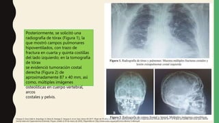 Posteriormente, se solicitó una
radiografía de tórax (Figura 1), la
que mostró campos pulmonares
hipoventilados, con trazo de
fractura en cuarta y quinta costillas
del lado izquierdo; en la tomografía
de tórax
se evidenció tumoración costal
derecha (Figura 2) de
aproximadamente 87 x 40 mm, así
como, múltiples imágenes
osteolíticas en cuerpo vertebral,
arcos
costales y pelvis.
Vásquez S, Sosa Valle H, Arquiñigo LS, Elena D, Arteaga Z, Vasquez S, et al. Caso clínico 04-2017. Mujer de 70 años con dolor óseo, alteración del sensorio e hipercalcemia Clinical case 04-2017. A 70 year old woman with bone pain, altered
mental state and hypercalcemia [Internet]. Org.pe. [citado el 29 de marzo de 2022]. Disponible en: http://www.scielo.org.pe/pdf/rmh/v28n4/a11v28n4.pdf
 