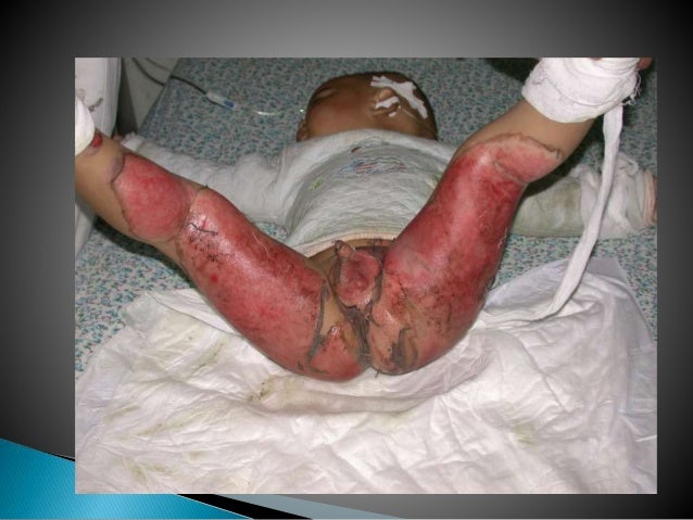 prevalence of esbl in surgical wound infections and burns Mrsa prevalence in our centre was very high 94 study of hospital acquired infections in burns patients b &lindsay rburn wound infections clin. prevalence of esbl in surgical wound infections and burns Mrsa prevalence in our centre was very high 94 study of hospital acquired infections in burns patients b &lindsay rburn wound infections clin.