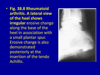 • Fig. 38.8 Rheumatoid
arthritis. A lateral view
of the heel shows
irregular erosive change
along the base of the
heel in association with
a small plantar spur.
Erosive change is also
demonstrated
posteriorly at the
insertion of the tendo
Achillis.
 