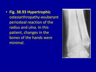 • Fig. 38.93 Hypertrophic
osteoarthropathy-exuberant
periosteal reaction of the
radius and ulna. In this
patient, changes in the
bones of the hands were
minimal.
 