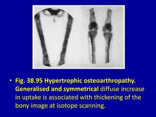 • Fig. 38.95 Hypertrophic osteoarthropathy.
Generalised and symmetrical diffuse increase
in uptake is associated with thickening of the
bony image at isotope scanning.
 