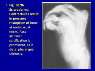 • Fig. 38.96
Scleroderma.
Contractures result
in pressure
resorption of bone
at metacarpal
necks. Para-
articular
calcification is
prominent, as is
distal phalangeal
sclerosis.
 