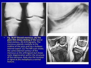 • Fig. 38.97 Discoid meniscus. (A) The
plain film shows dishing of the lateral
tibial plateau. (B) Arthrography. The
meniscus extends medially to the
midline of the joint and has a bulbous
internal aspect. (C) The MR scan shows
the same external contour of the
meniscus as the arthrogram but shows
cystic degeneration within the structure
of the meniscus. Note also the increase
in signal at the metaphysis-a normal
feature.
 