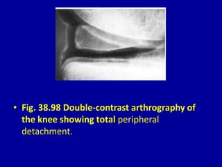 • Fig. 38.98 Double-contrast arthrography of
the knee showing total peripheral
detachment.
 