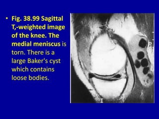 • Fig. 38.99 Sagittal
T,-weighted image
of the knee. The
medial meniscus is
torn. There is a
large Baker's cyst
which contains
loose bodies.
 