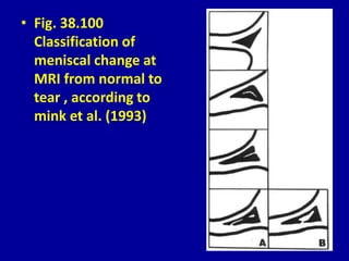 • Fig. 38.100
Classification of
meniscal change at
MRI from normal to
tear , according to
mink et al. (1993)
 