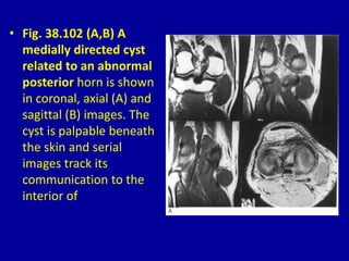 • Fig. 38.102 (A,B) A
medially directed cyst
related to an abnormal
posterior horn is shown
in coronal, axial (A) and
sagittal (B) images. The
cyst is palpable beneath
the skin and serial
images track its
communication to the
interior of
 