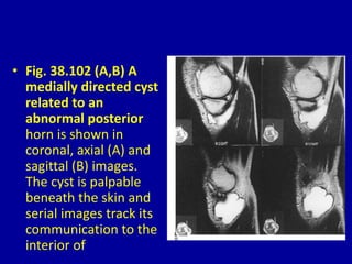 • Fig. 38.102 (A,B) A
medially directed cyst
related to an
abnormal posterior
horn is shown in
coronal, axial (A) and
sagittal (B) images.
The cyst is palpable
beneath the skin and
serial images track its
communication to the
interior of
 