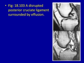 • Fig: 18.103 A disrupted
posterior cruciate ligament
surrounded by effusion.
 