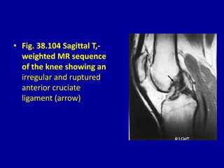 • Fig. 38.104 Sagittal T,-
weighted MR sequence
of the knee showing an
irregular and ruptured
anterior cruciate
ligament (arrow)
 