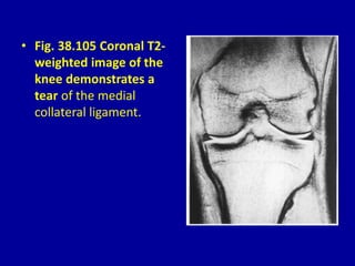 • Fig. 38.105 Coronal T2-
weighted image of the
knee demonstrates a
tear of the medial
collateral ligament.
 