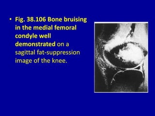 • Fig. 38.106 Bone bruising
in the medial femoral
condyle well
demonstrated on a
sagittal fat-suppression
image of the knee.
 