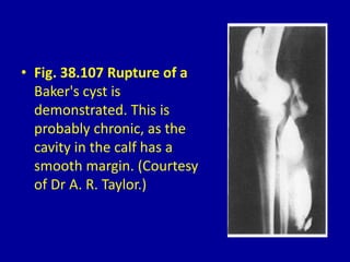 • Fig. 38.107 Rupture of a
Baker's cyst is
demonstrated. This is
probably chronic, as the
cavity in the calf has a
smooth margin. (Courtesy
of Dr A. R. Taylor.)
 