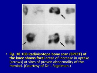• Fig. 38.108 Radioisotope bone scan (SPECT) of
the knee shows focal areas of increase in uptake
(arrows) at sites of proven abnormality of the
menisci. (Courtesy of Dr I. Fogelman.)
 