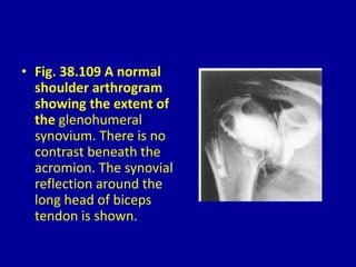 • Fig. 38.109 A normal
shoulder arthrogram
showing the extent of
the glenohumeral
synovium. There is no
contrast beneath the
acromion. The synovial
reflection around the
long head of biceps
tendon is shown.
 