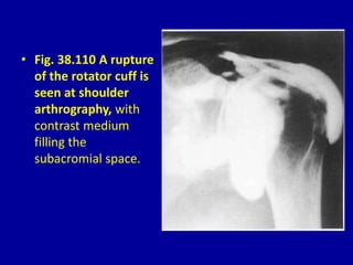 • Fig. 38.110 A rupture
of the rotator cuff is
seen at shoulder
arthrography, with
contrast medium
filling the
subacromial space.
 