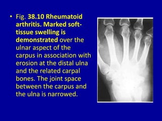 • Fig. 38.10 Rheumatoid
arthritis. Marked soft-
tissue swelling is
demonstrated over the
ulnar aspect of the
carpus in association with
erosion at the distal ulna
and the related carpal
bones. The joint space
between the carpus and
the ulna is narrowed.
 
