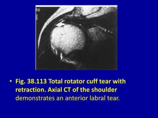 • Fig. 38.113 Total rotator cuff tear with
retraction. Axial CT of the shoulder
demonstrates an anterior labral tear.
 
