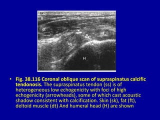 • Fig. 38.116 Coronal oblique scan of supraspinatus calcific
tendonosis. The supraspinatus tendon (ss) is of
heterogeneous low echogenicity with foci of high
echogenicity (arrowheads), some of which cast acoustic
shadow consistent with calcification. Skin (sk), fat (ft),
deltoid muscle (dt) And humeral head (H) are shown
 