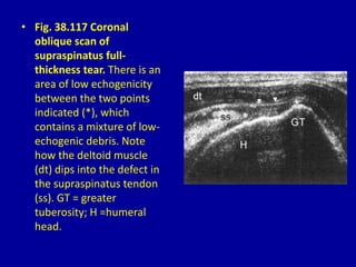 • Fig. 38.117 Coronal
oblique scan of
supraspinatus full-
thickness tear. There is an
area of low echogenicity
between the two points
indicated (*), which
contains a mixture of low-
echogenic debris. Note
how the deltoid muscle
(dt) dips into the defect in
the supraspinatus tendon
(ss). GT = greater
tuberosity; H =humeral
head.
 