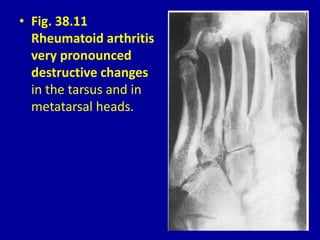 • Fig. 38.11
Rheumatoid arthritis
very pronounced
destructive changes
in the tarsus and in
metatarsal heads.
 