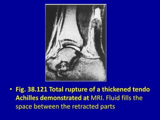 • Fig. 38.121 Total rupture of a thickened tendo
Achilles demonstrated at MRI. Fluid fills the
space between the retracted parts
 