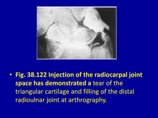 • Fig. 38.122 Injection of the radiocarpal joint
space has demonstrated a tear of the
triangular cartilage and filling of the distal
radioulnar joint at arthrography.
 