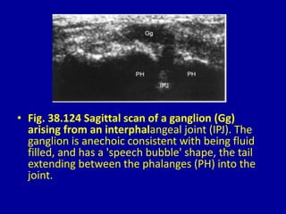 • Fig. 38.124 Sagittal scan of a ganglion (Gg)
arising from an interphalangeal joint (IPJ). The
ganglion is anechoic consistent with being fluid
filled, and has a 'speech bubble' shape, the tail
extending between the phalanges (PH) into the
joint.
 