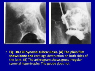 • Fig. 38.126 Synovial tuberculosis. (A) The plain film
shows bone and cartilage destruction on both sides of
the joint. (B) The arthrogram shows gross irregular
synovial hypertrophy. The geode does not
 